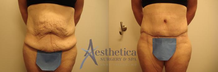 Tummy Tuck Case 720 Before & After Front | Columbus, OH | Aesthetica Surgery & Spa