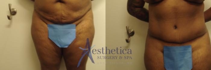 Tummy Tuck Case 726 Before & After Front | Columbus, OH | Aesthetica Surgery & Spa