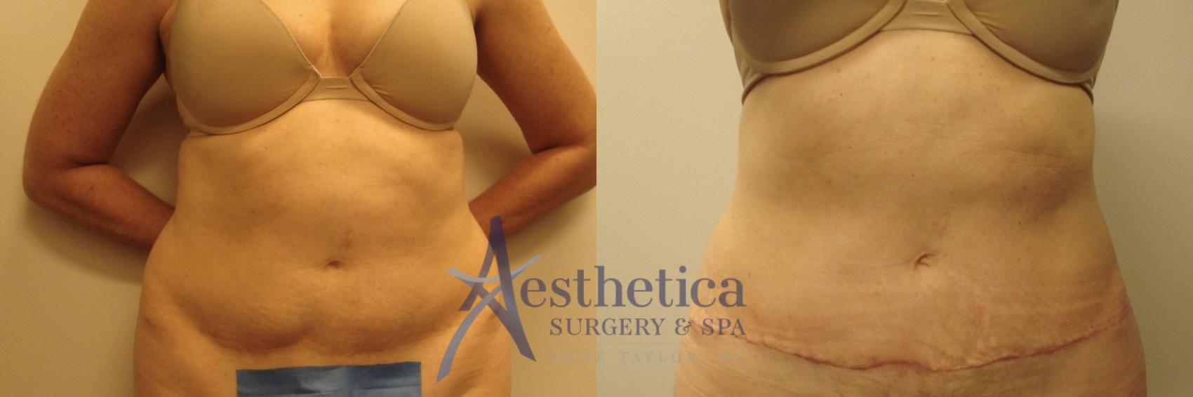 Tummy Tuck Case 747 Before & After Front | Columbus, OH | Aesthetica Surgery & Spa