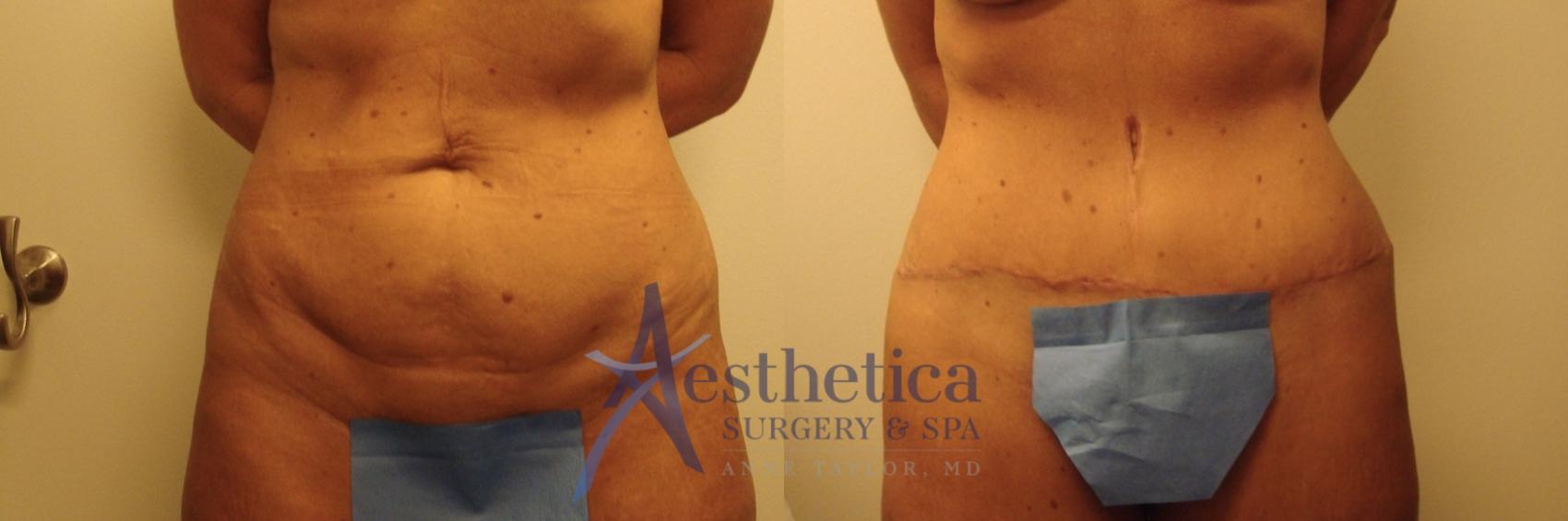 Tummy Tuck Case 749 Before & After Front | Columbus, OH | Aesthetica Surgery & Spa