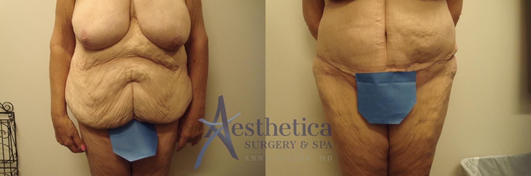 Tummy Tuck Case 753 Before & After Front | Columbus, OH | Aesthetica Surgery & Spa