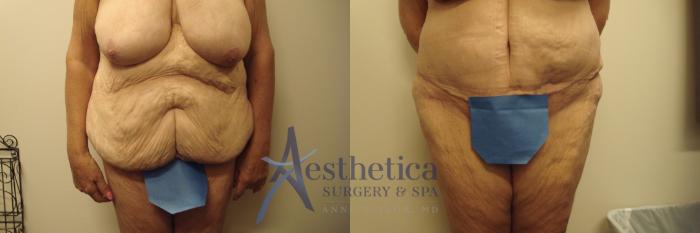 Tummy Tuck Case 753 Before & After Front | Columbus, OH | Aesthetica Surgery & Spa