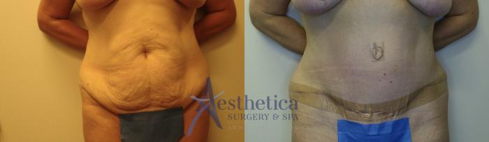 Tummy Tuck Case 765 Before & After Front | Columbus, OH | Aesthetica Surgery & Spa