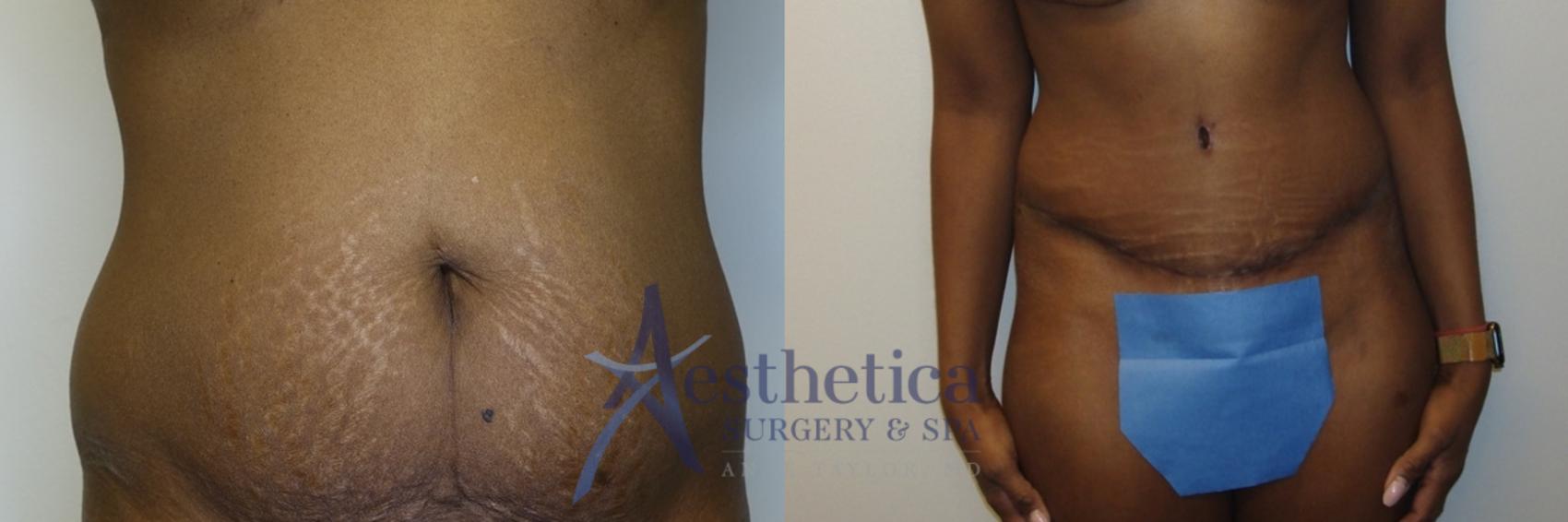 Tummy Tuck Case 767 Before & After Front | Columbus, OH | Aesthetica Surgery & Spa