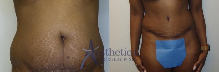 Tummy Tuck Case 767 Before & After Front | Columbus, OH | Aesthetica Surgery & Spa