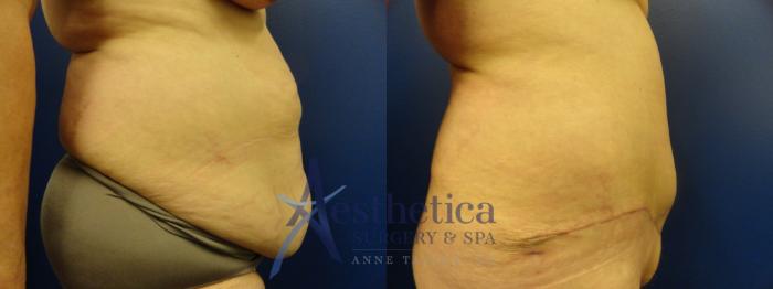 Tummy Tuck Case 77 Before & After View #1 | Columbus, OH | Aesthetica Surgery & Spa