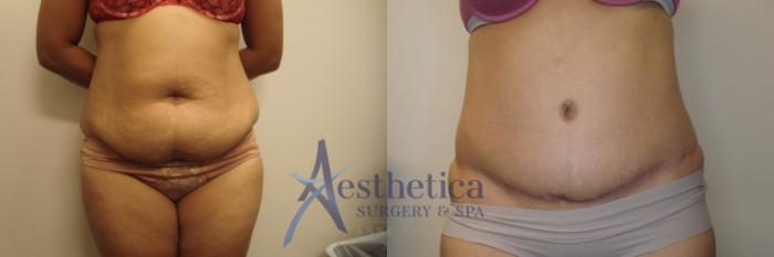 Tummy Tuck Case 786 Before & After Front | Columbus, OH | Aesthetica Surgery & Spa