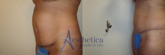 Tummy Tuck Case 788 Before & After Left Oblique | Columbus, OH | Aesthetica Surgery & Spa