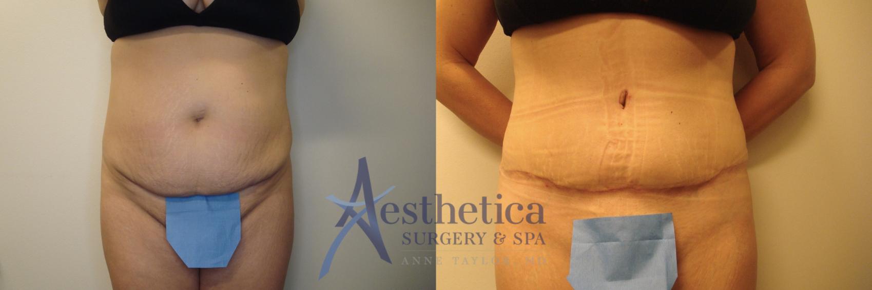 Tummy Tuck Case 796 Before & After Front | Columbus, OH | Aesthetica Surgery & Spa