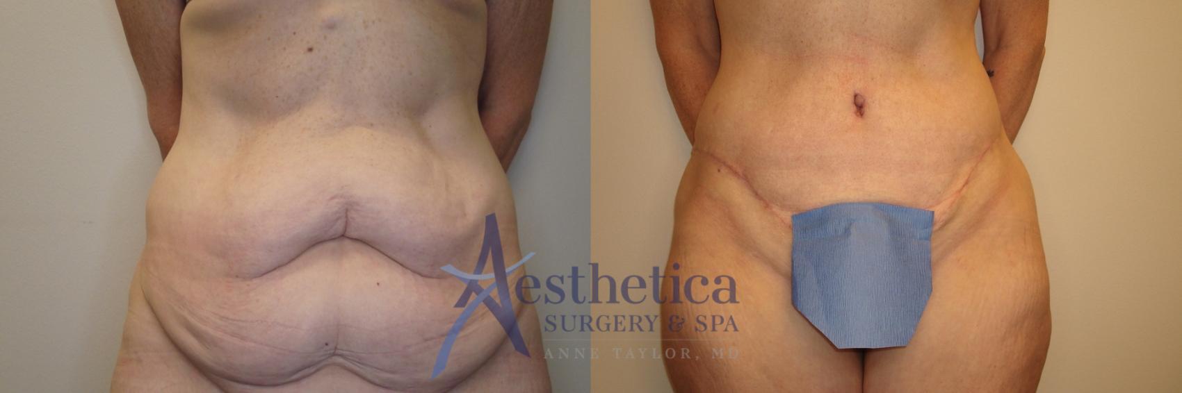 Tummy Tuck Case 798 Before & After Front | Columbus, OH | Aesthetica Surgery & Spa