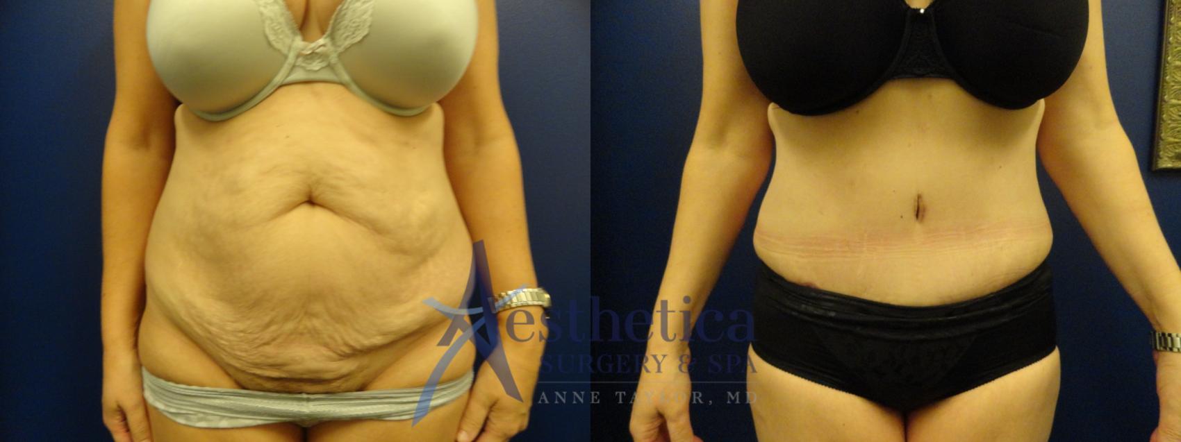 Tummy Tuck Case 80 Before & After View #1 | Columbus, OH | Aesthetica Surgery & Spa