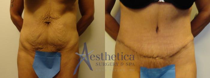 Tummy Tuck Case 822 Before & After Front | Columbus, OH | Aesthetica Surgery & Spa