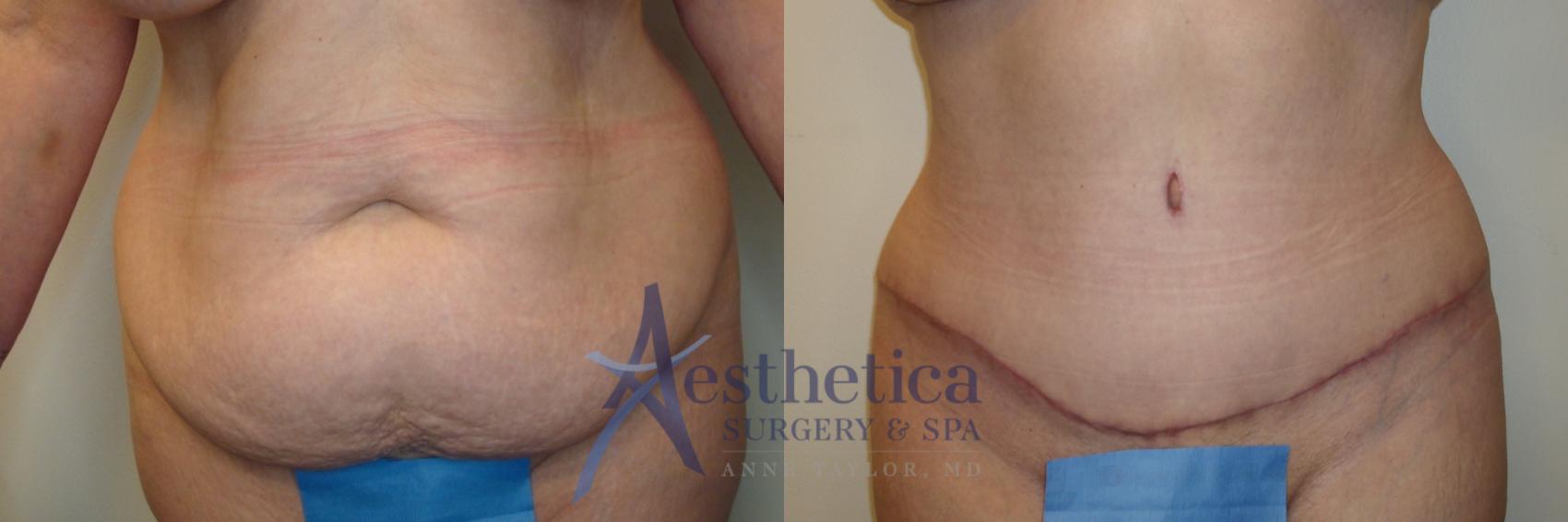 Tummy Tuck Case 824 Before & After Front | Columbus, OH | Aesthetica Surgery & Spa