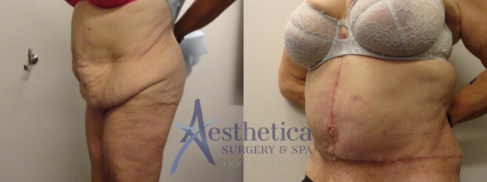 Tummy Tuck Case 836 Before & After Front | Columbus, OH | Aesthetica Surgery & Spa