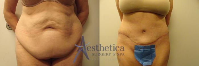 Tummy Tuck Case 841 Before & After Front | Columbus, OH | Aesthetica Surgery & Spa