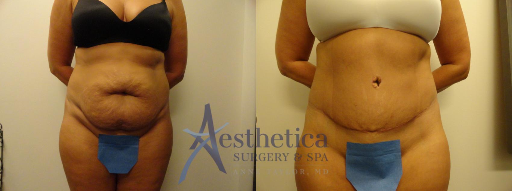Tummy Tuck Case 863 Before & After Front | Columbus, OH | Aesthetica Surgery & Spa