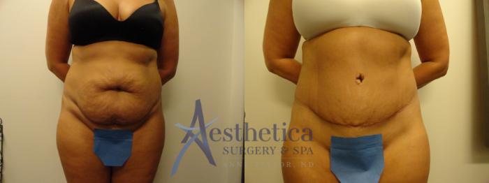 Tummy Tuck Case 863 Before & After Front | Columbus, OH | Aesthetica Surgery & Spa