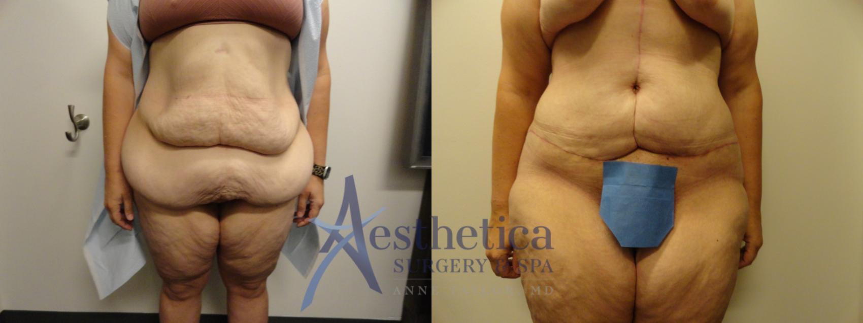 Tummy Tuck Case 864 Before & After Front | Columbus, OH | Aesthetica Surgery & Spa