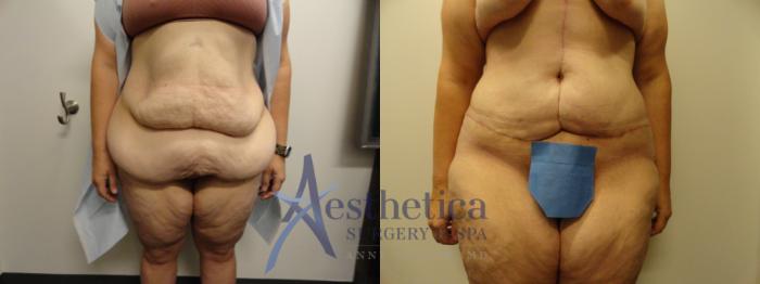 Tummy Tuck Case 864 Before & After Front | Columbus, OH | Aesthetica Surgery & Spa