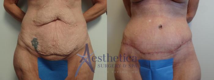 Tummy Tuck Case 883 Before & After Front | Columbus, OH | Aesthetica Surgery & Spa