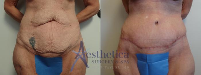 Tummy Tuck Case 889 Before & After Front | Columbus, OH | Aesthetica Surgery & Spa
