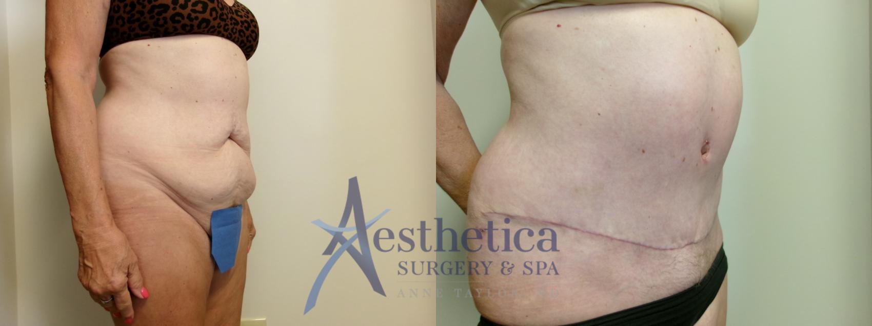 Tummy Tuck Case 908 Before & After Right Oblique | Columbus, OH | Aesthetica Surgery & Spa
