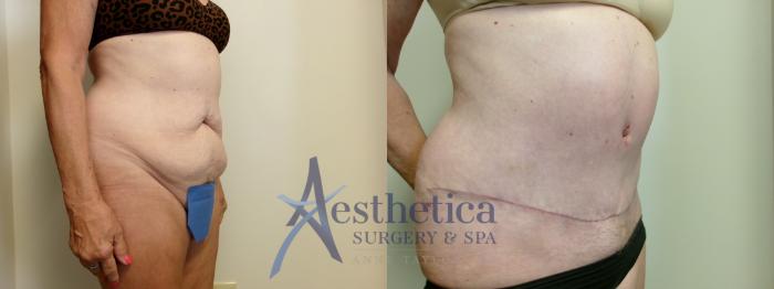 Tummy Tuck Case 908 Before & After Right Oblique | Columbus, OH | Aesthetica Surgery & Spa