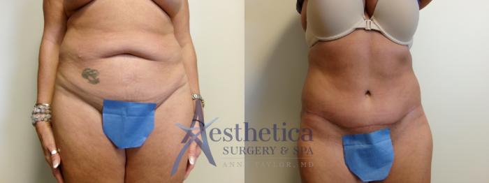 Tummy Tuck Case 911 Before & After Front | Columbus, OH | Aesthetica Surgery & Spa