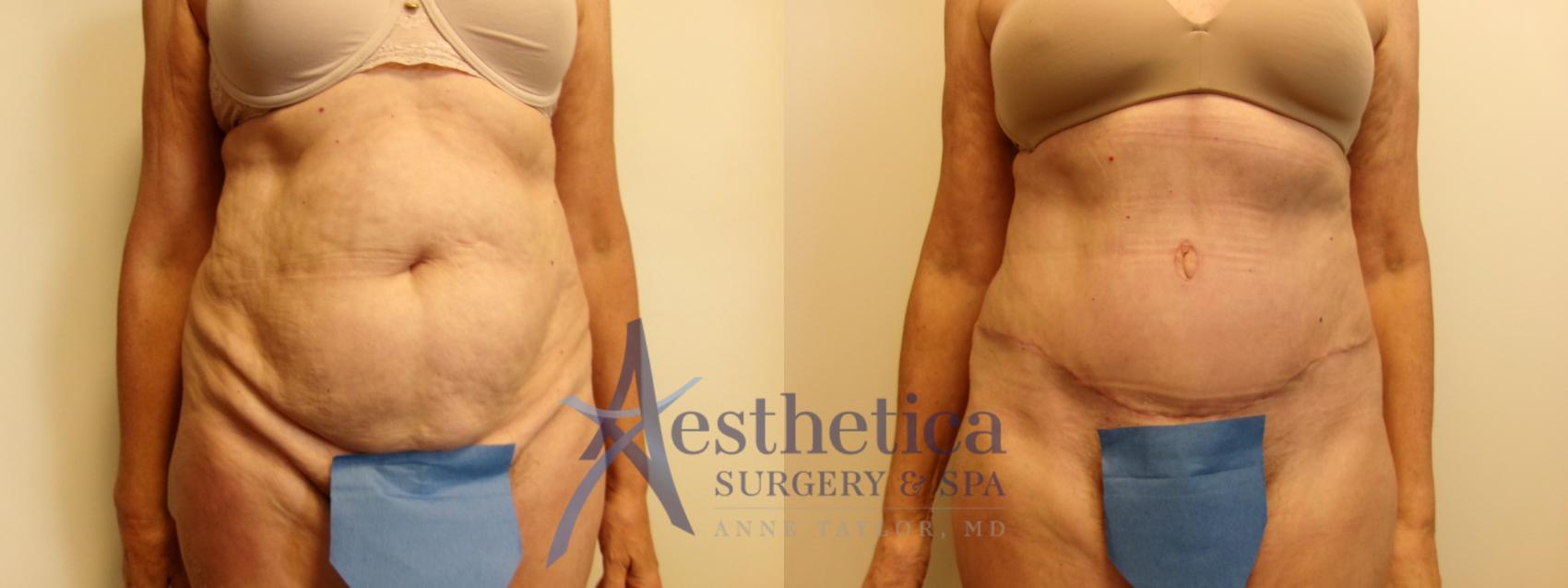 Tummy Tuck Case 914 Before & After Front | Columbus, OH | Aesthetica Surgery & Spa