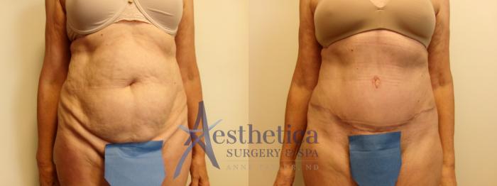 Tummy Tuck Case 914 Before & After Front | Columbus, OH | Aesthetica Surgery & Spa