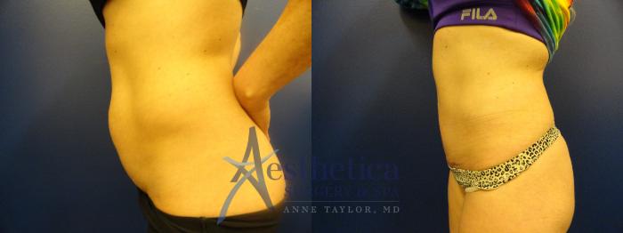 Tummy Tuck Case 94 Before & After View #1 | Columbus, OH | Aesthetica Surgery & Spa